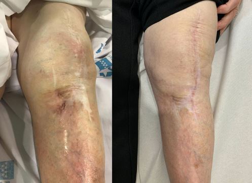 ورم پا و کبودی بعد از جراحی عمل تعویض مفصل زانو